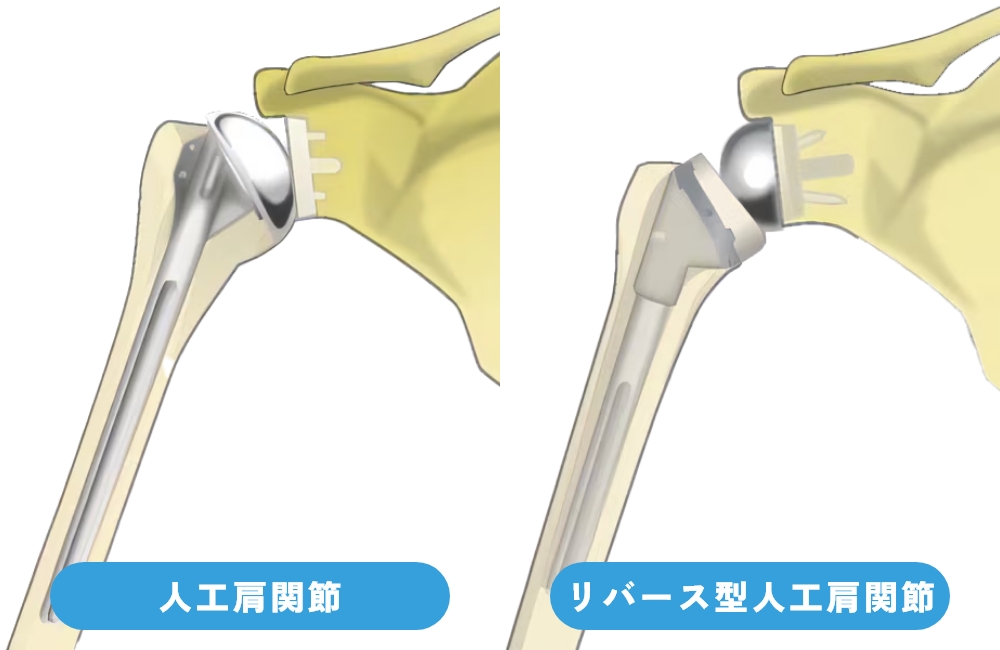人工肩関節置換術 | 札幌いがらし人工関節クリニック